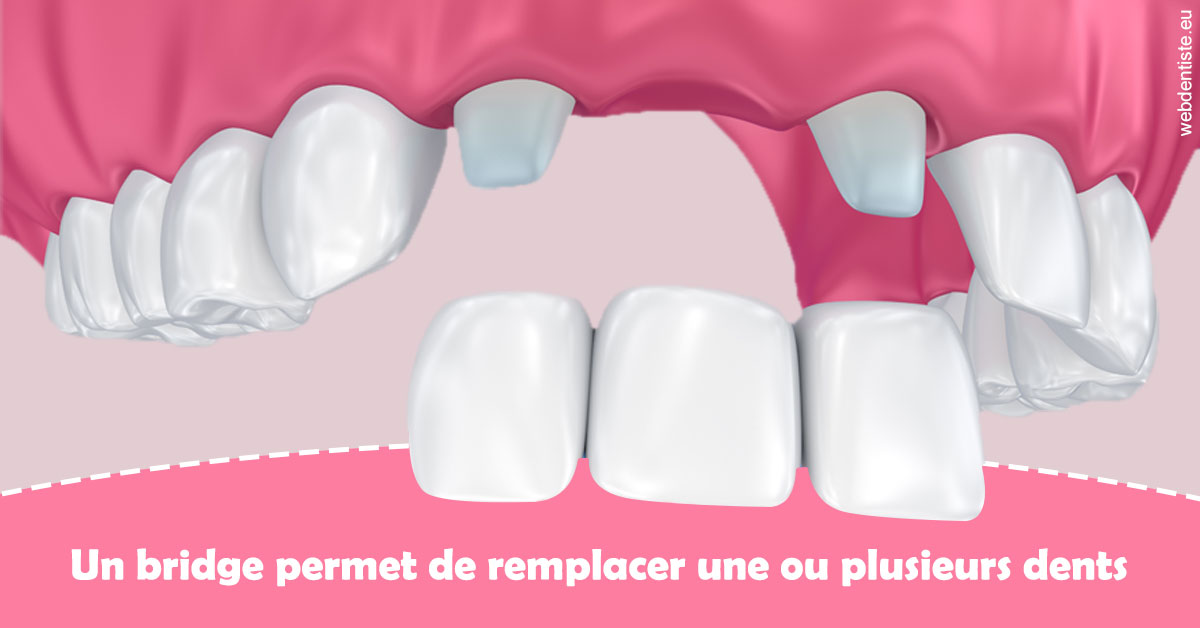 https://www.drgoddefroy.fr/Bridge remplacer dents 2