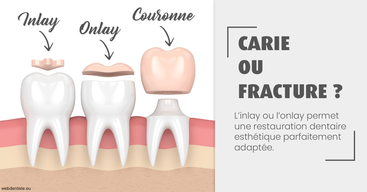 https://www.drgoddefroy.fr/T2 2023 - Carie ou fracture 1