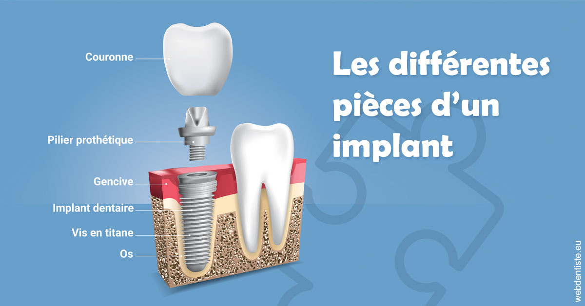 https://www.drgoddefroy.fr/Les différentes pièces d’un implant 1
